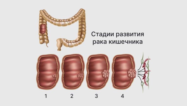 Лечение дисбактериоза кишечника у грудничков. Лечение дисбактериоза кишечника у грудничков